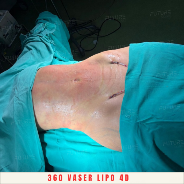 Before and after body-contouring result at Future Clinic Turkey