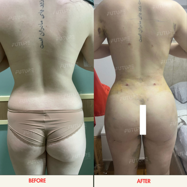 Before and after body-contouring result at Future Clinic Turkey