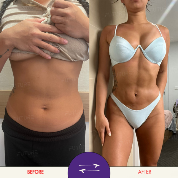 Before and after body-contouring result at Future Clinic Turkey