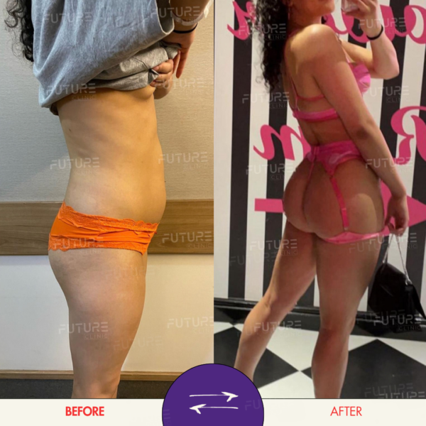 Before and after body-contouring result at Future Clinic Turkey
