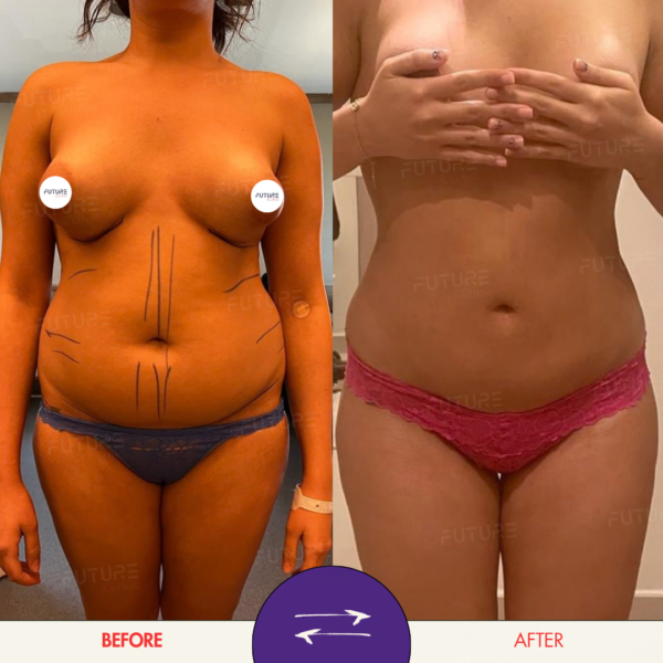 Before and after body-contouring result at Future Clinic Turkey