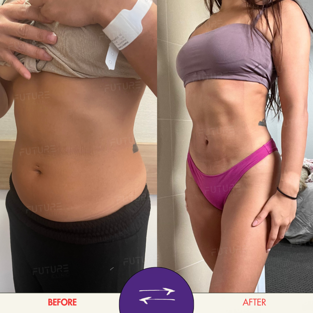 Before and after plastic surgery result at Future Clinic Turkey