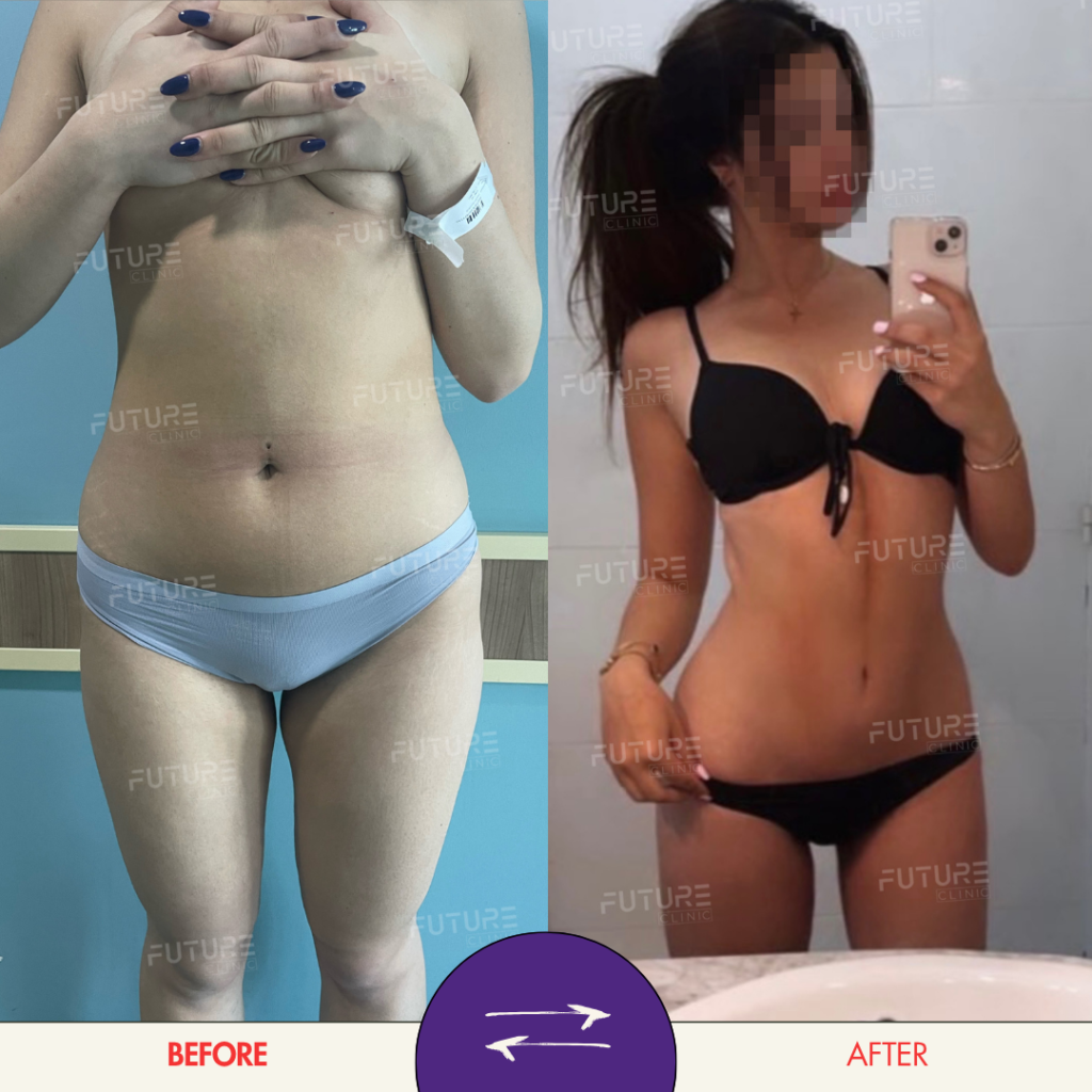 Before and after plastic surgery result at Future Clinic Turkey