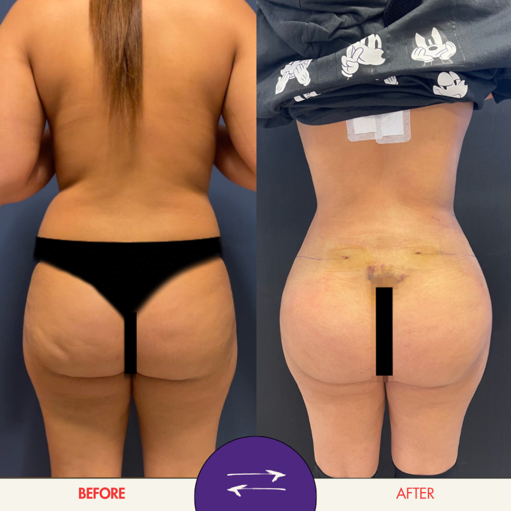 Before and after plastic surgery result at Future Clinic Turkey