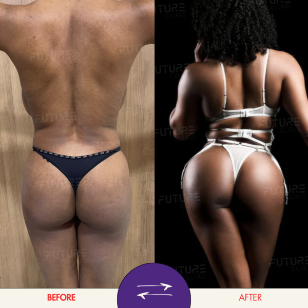 Before and after body-contouring result at Future Clinic Turkey