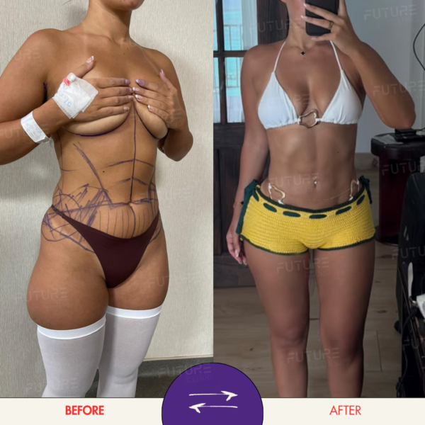 Before and after body-contouring result at Future Clinic Turkey