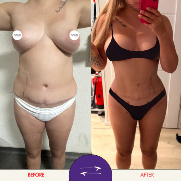 Before and after body-contouring result at Future Clinic Turkey