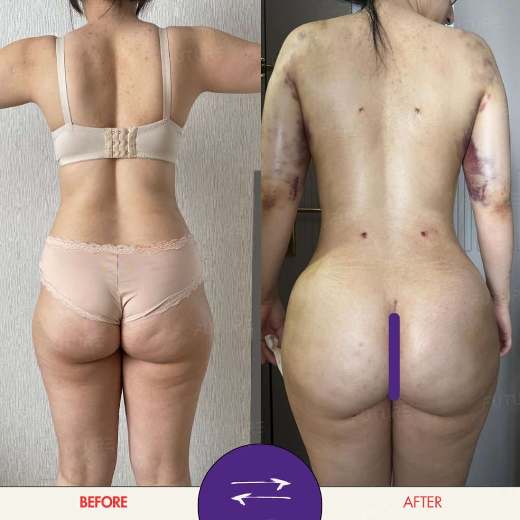 Before and after plastic surgery result at Future Clinic Turkey