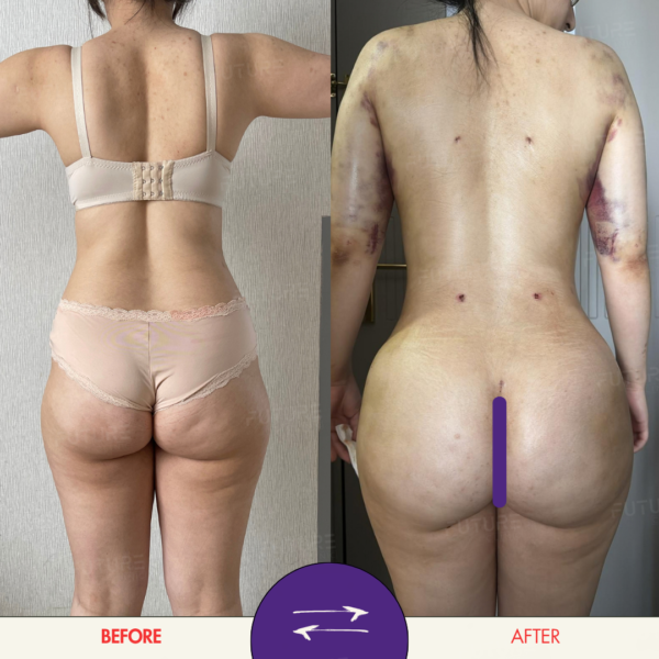 Before and after body-contouring result at Future Clinic Turkey