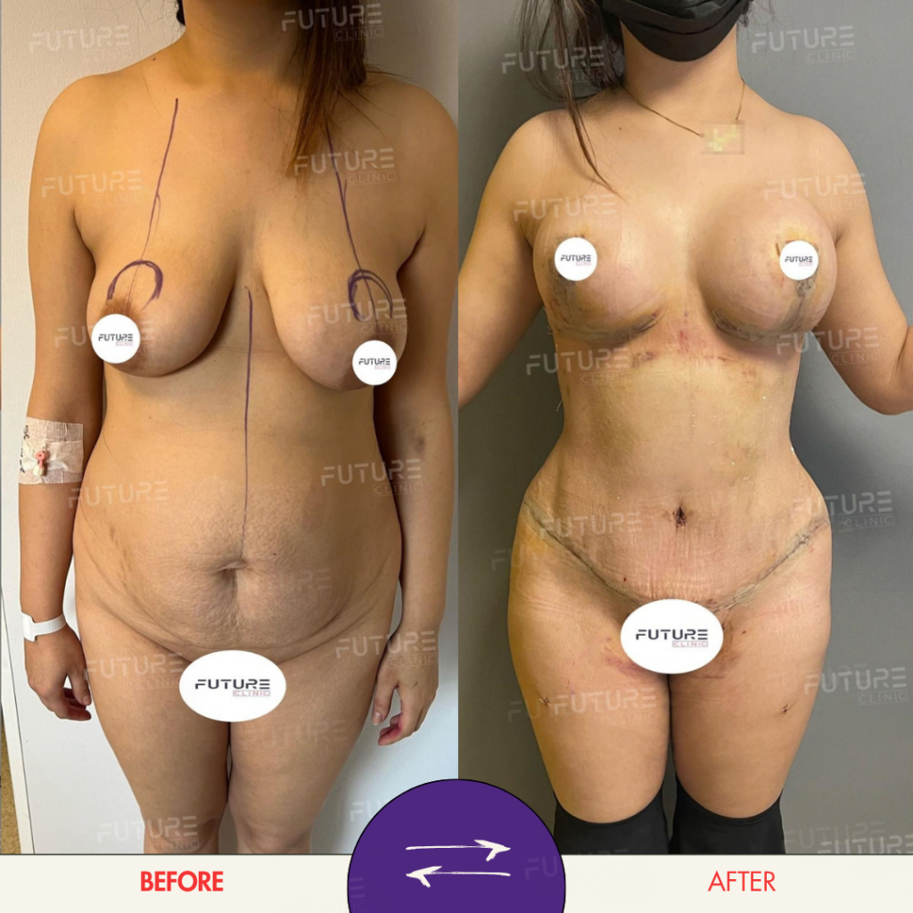 Before and after plastic surgery result at Future Clinic Turkey