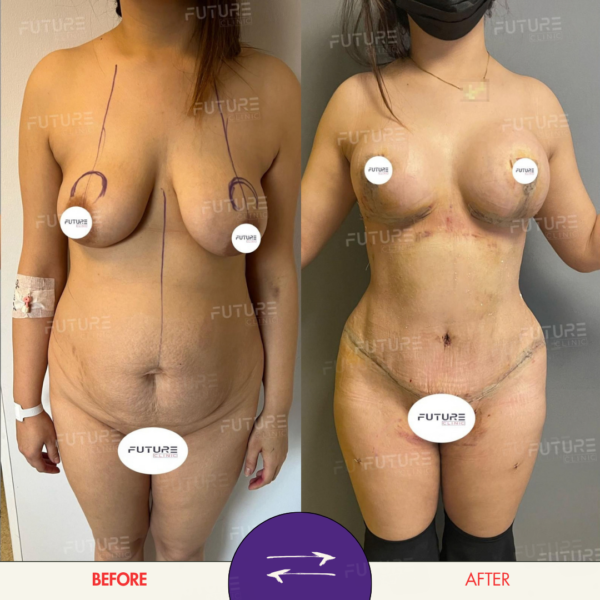 Before and after body-contouring result at Future Clinic Turkey