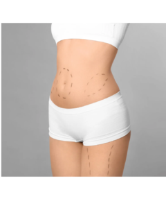 Tummy Tuck